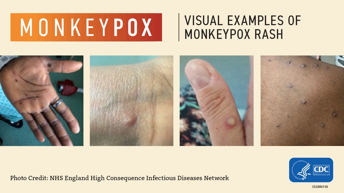 monkeypox visual of physical white bumps forming on a hand 